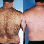 laser hair removal before and after back body