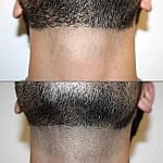 men facial hair removal treatment men beard laser hair removal