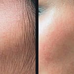 sidebruns laser hair removal ilford