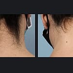 Laser hair removal results after 2 sessions