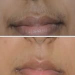 upper lip laser hair removal offers permanent solution of unwanted hair removal