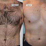 Permanent laser hair removal before and after