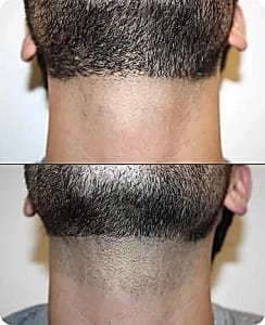 men facial hair removal treatment men beard laser hair removal