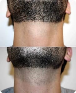 Beard laser hair removal