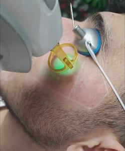 Laser technician performing men’s laser hair removal Ilford beard line shaping