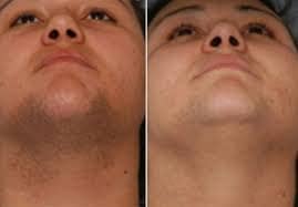 Before and after results of best laser hair removal for women Ilford face treatment