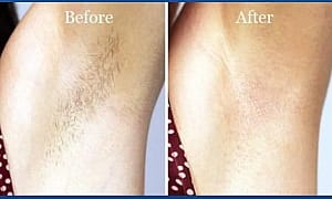 Laser hair removal Before and after men