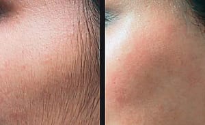 sidebruns laser hair removal ilford