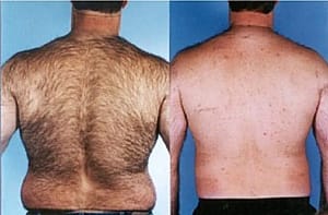 laser hair removal before and after back body