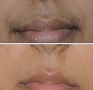 upper lip laser hair removal offers permanent solution of unwanted hair removal