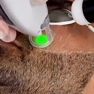 Men Beard Shaping laser hair removal
