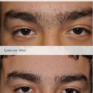 middle of eyebrows laser hair remova;