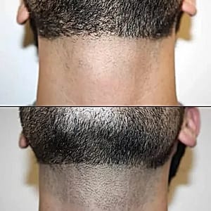 men facial hair removal treatment men beard laser hair removal
