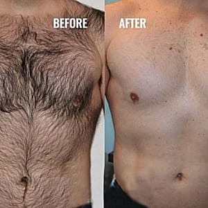 Permanent laser hair removal before and after