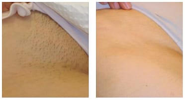 Hollywood Bikini Laser Hair Removal Clinic in Ilford London
