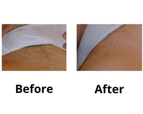 full brazilian laser hair removal before and after photos