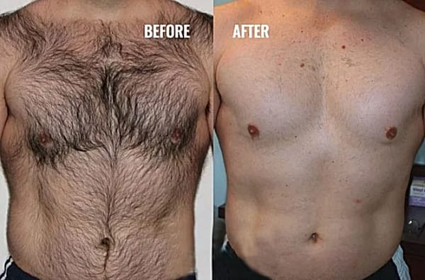 Permanent laser hair removal before and after