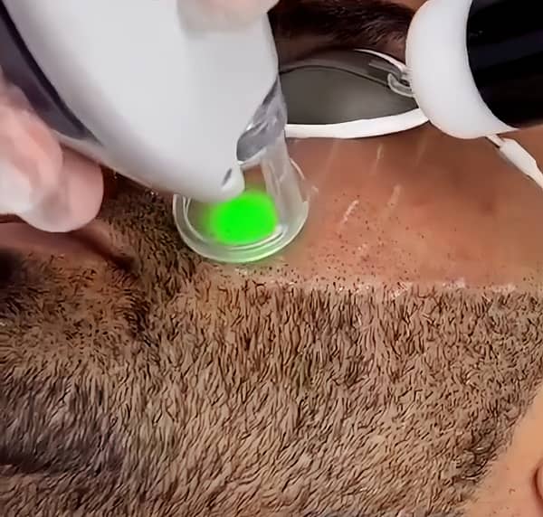 men face beard laser shaping