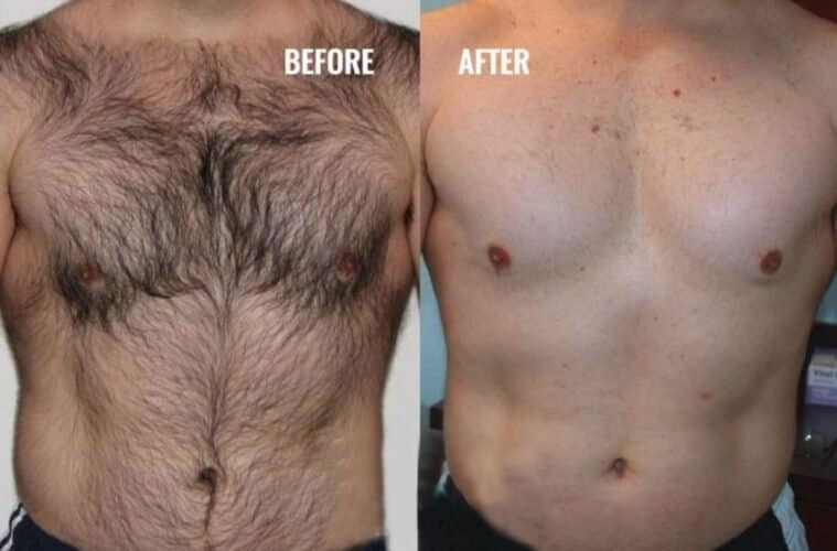 Before and after men’s laser hair removal Ilford on back
