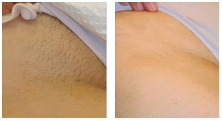 Hollywood Laser Hair Removal Before and After Results