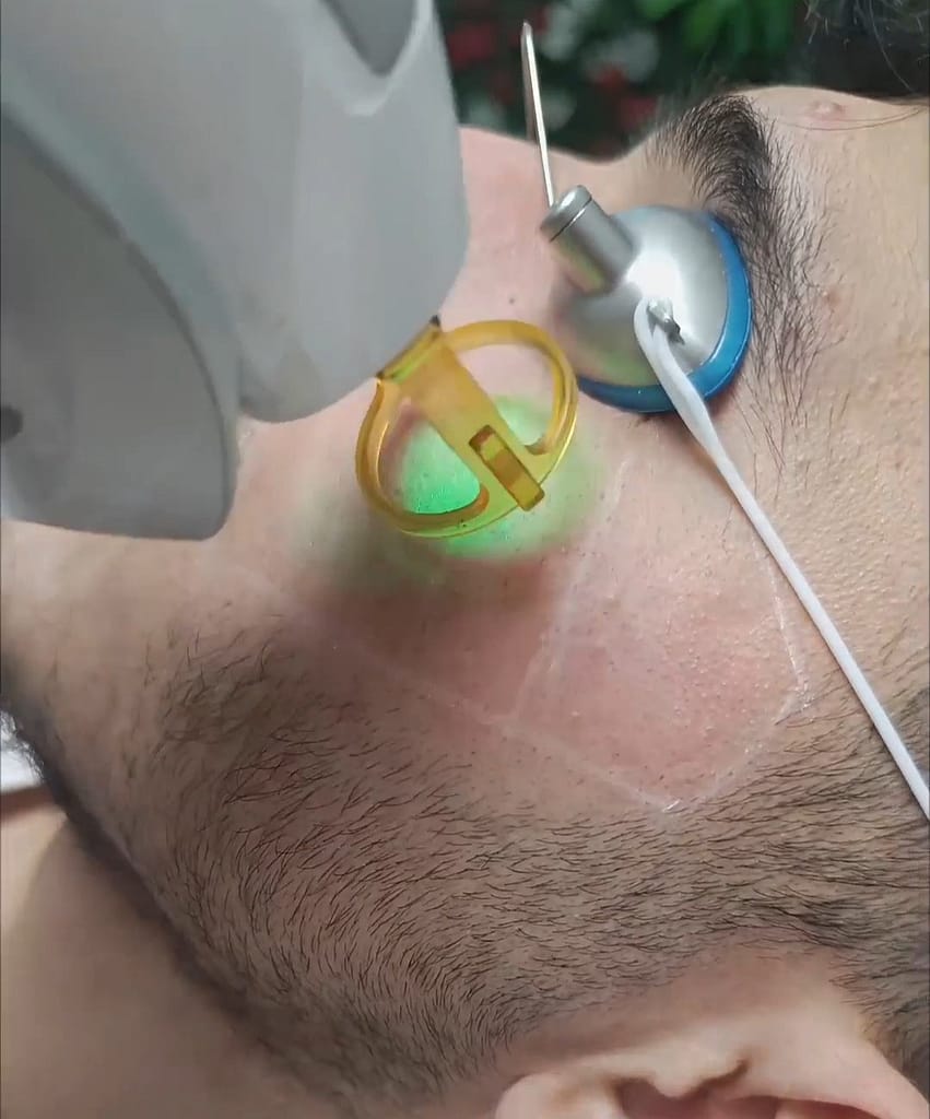 Men Beard laser hair removal