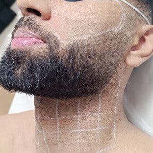 Men Facial Hair Removal Laser Beard Laser Shaping